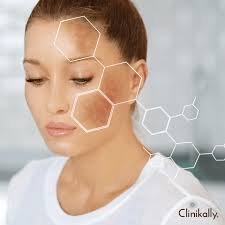 Skin For Hyperpigmentation